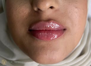 Lips