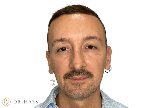 Dr Hass - Masculinization