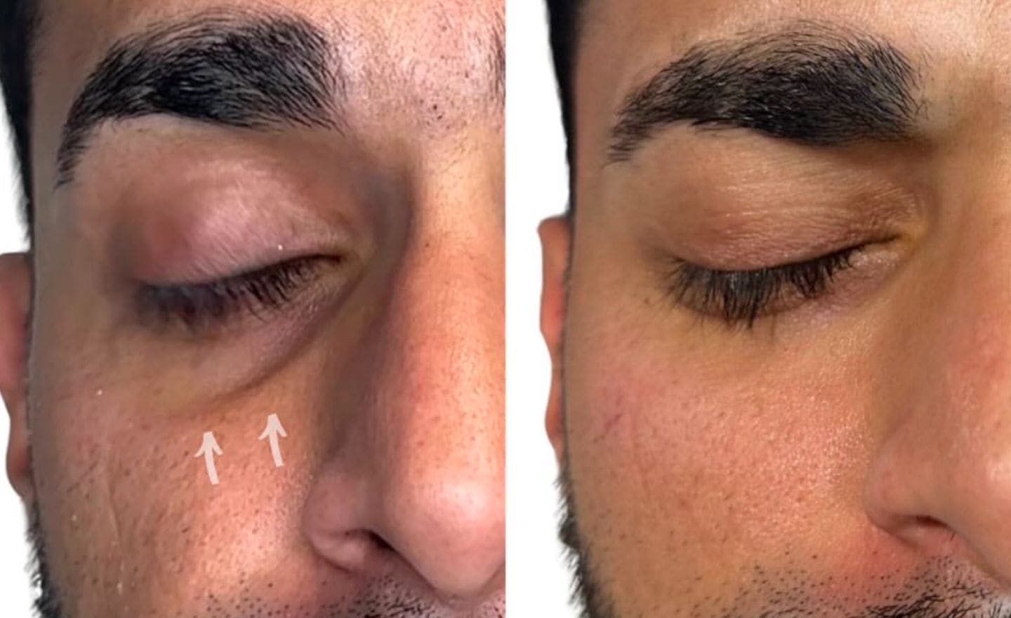 tear trough filler before & after