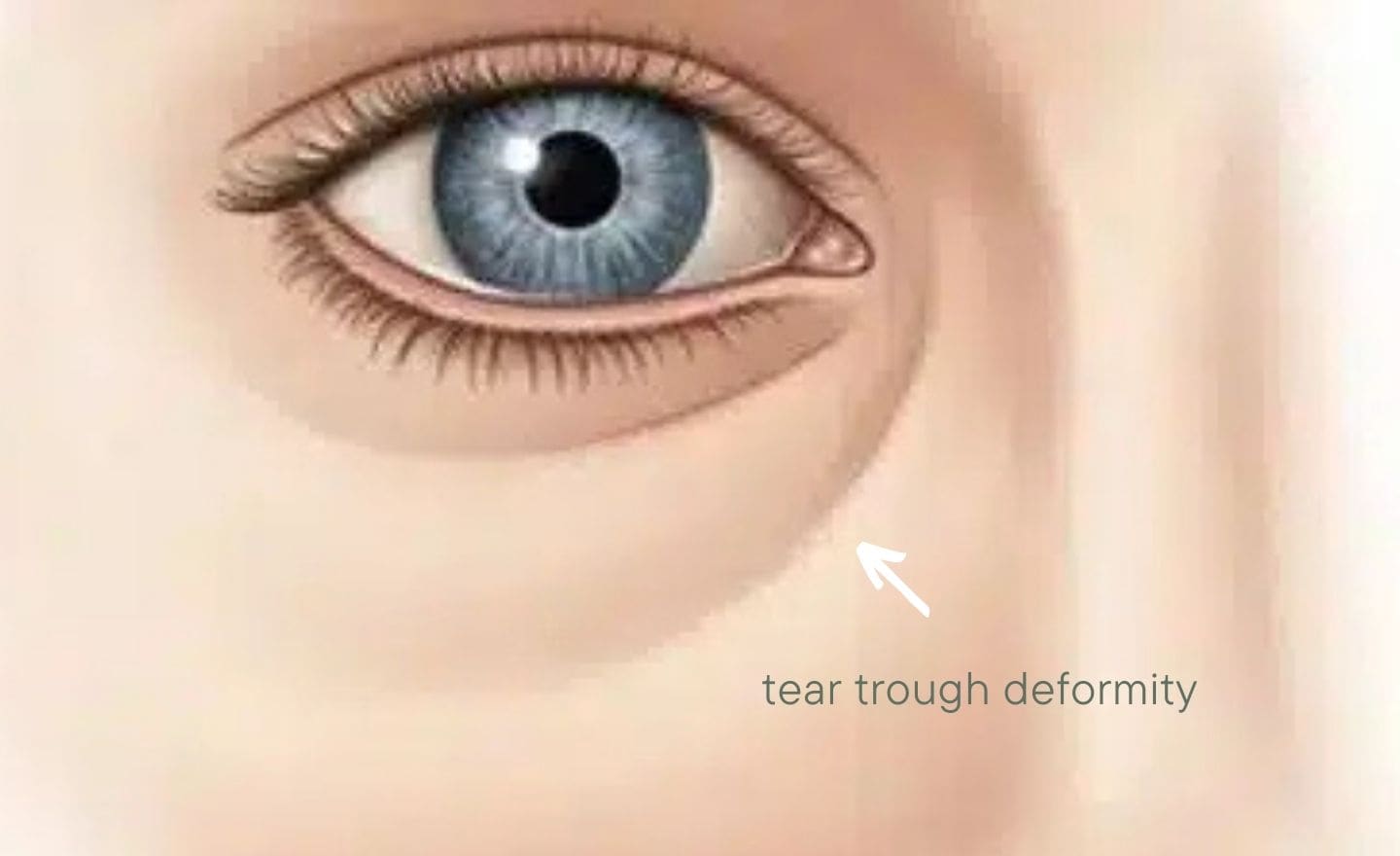 tear trough deformity