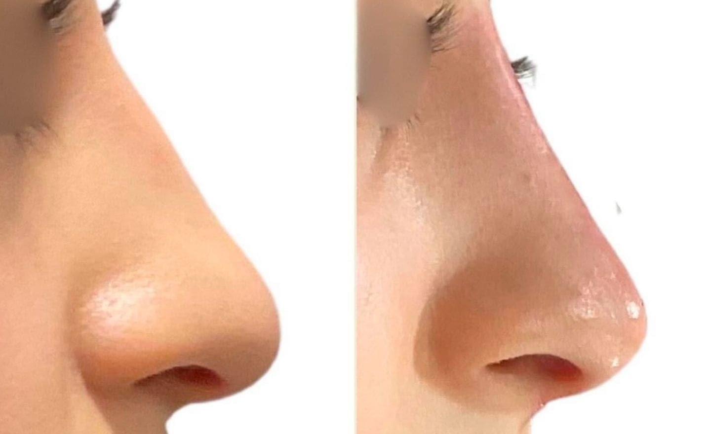 Non-Surgical Nose Jobs before and after