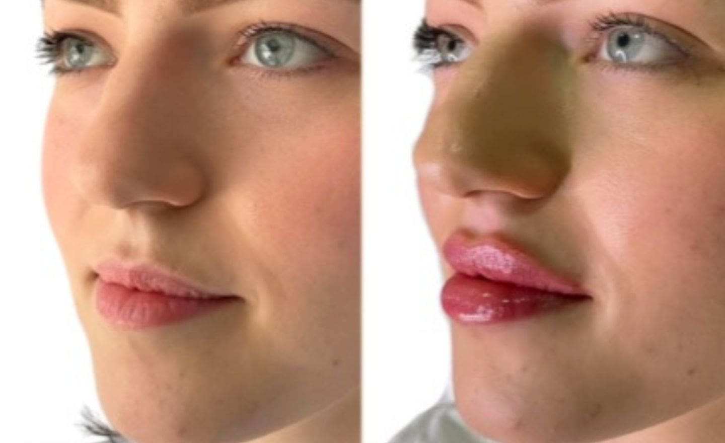 1ml lip filler before & after