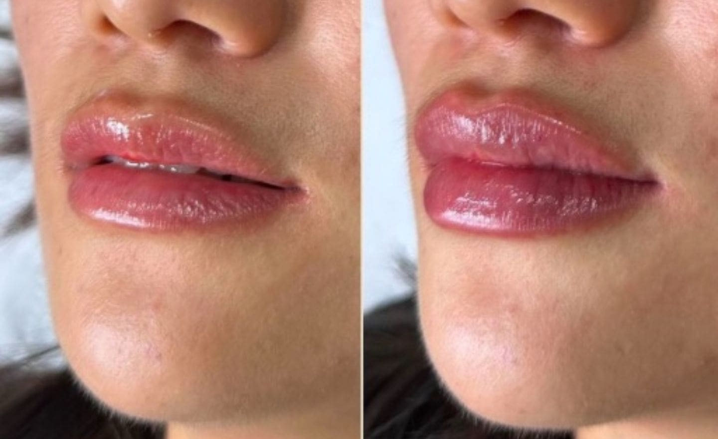 0.5ml Lip Filler: before and after