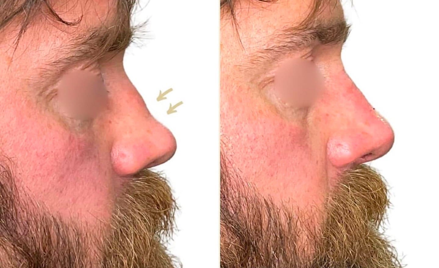 Non-Surgical Nose Jobs